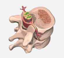 Hemangiom spinării: cauze, simptome, cum de a trata, recomandări