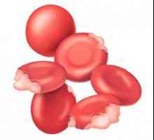 Anemia hemolitica: cauze, tipuri, simptome, diagnostic, tratament