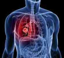 Simptomele de hemoragie pulmonară și de prim ajutor