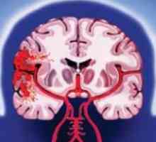 Hemoragică atacul cerebral: tipuri, simptome, diagnostic, tratament, factori de risc