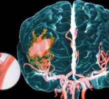 Accident vascular cerebral hemoragic: caracteristici clinice și de diagnostic