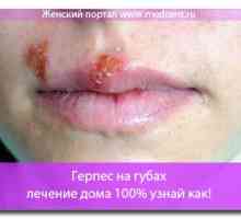 Herpes pe buze - tratament de 100% la domiciliu pentru a afla cum!
