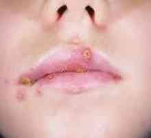 Herpes pe buze la copii