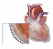 Hydropericardium: aspect, simptome, forma (mici, exprimate) pentru a trata