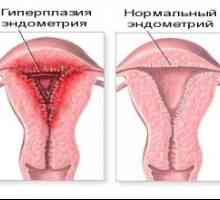 Hiperplazie endometrială: tratamentul cu medicamente și remedii populare