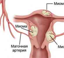Cancer endometrial Hiperplazia