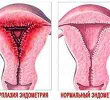 Hiperplazie endometrială în timpul menopauzei