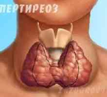 Hipertiroidism tiroidă