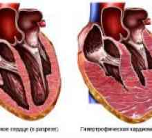 Cardiomiopatia hipertrofica la copii și adulți