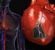 Principalele motive pentru infarctul miocardic extensiv