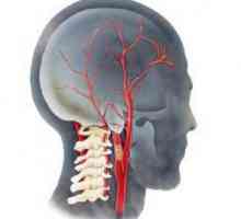 Hipoplazia arterei vertebrale: simptome, tratament, consecințe