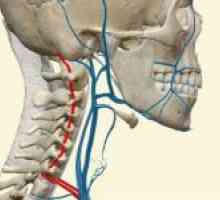 Hipoplazia arterelor vertebrale