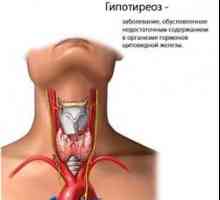 Hipotiroidia. Simptome si tratament