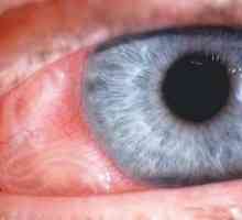 Toxocarioza Ocular: simptome, diagnostic, tratament