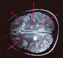 Glioza creier: cauze, simptome, diagnostic, tratament