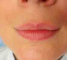 Buzele înainte și după administrarea de acid hialuronic: fotografii și comentarii