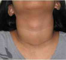 Simptomele tipice in boli ale glandei tiroide