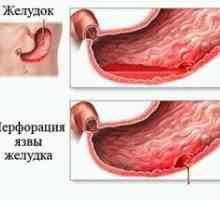 Tratamentul chirurgical al ulcerului gastric perforat