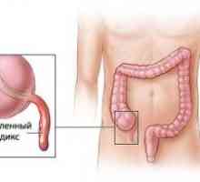 Cronice apendicita: simptome, cauze si tratament