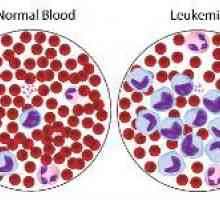 Cum de a trata leucemia sânge