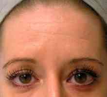 Botox anti-rid pe frunte