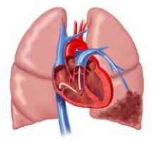 Pulmonare infarct: cauze, simptome, modul de a trata, efectele