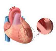 Infarct miocardic: cauze, semne timpurii, ajutor, terapie, reabilitare