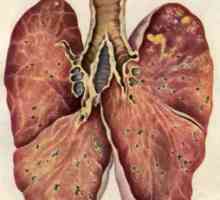 Perioada de incubație a tuberculozei, diagnostic și tratament