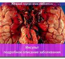 Accident vascular cerebral: boala TEXTE