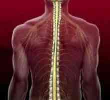 Accident vascular cerebral măduvei spinării