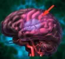 Accident vascular cerebral ischemic cerebral si tratamentul acesteia