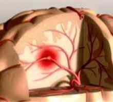 Principalele simptome ale unui accident vascular cerebral