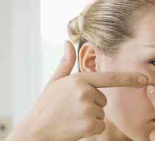 Utilizarea unguente Sulfargin pentru a elimina acnee