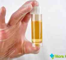 Culoarea galben strălucitor de urină: cauzele bolii și posibilele complicații