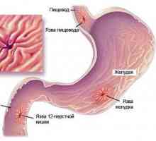 Ulcer gastric și duodenal