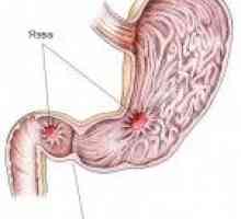 Ulcer gastric și ulcer duodenal: caracteristicile și cauzele