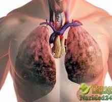 Tratamentul eficient al remedii populare fibroza pulmonara