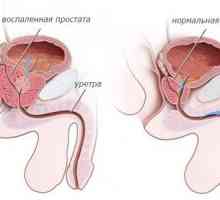 Tratamentul eficient al pietrelor in prostata
