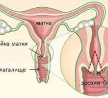 Eficacitatea tratamentului de lumânări de eroziune de col uterin