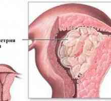 Medicamente eficiente pentru tratamentul fibrom uterin