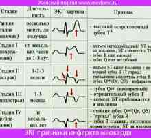 Semne ECG de infarct miocardic. Fotografii și explicații