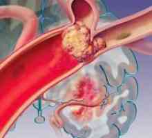 Embolie vasculare, arteriale: tipuri, simptome, tratament, prevenire
