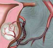 Embolizarea arterelor miomul uterin: dovezi, proceduri, rezultate