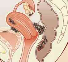 Endometrioza si Sarcina