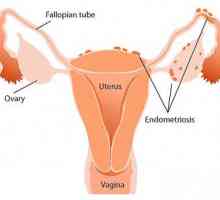 Simptomele endometriozei uterine și tratament