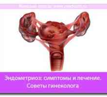 Endometrioza: Simptome si tratament. Sfaturi ginecolog