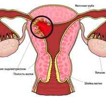 Uterină endometrioza: Ce tipuri?