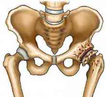 Endoprotezare - Hip înlocuire