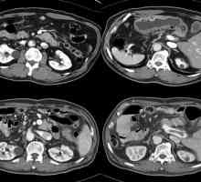 Etapele care se pregătesc pentru CT abdominal cu contrast