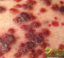 Tratamentul de calitate de remedii populare herpes zoster